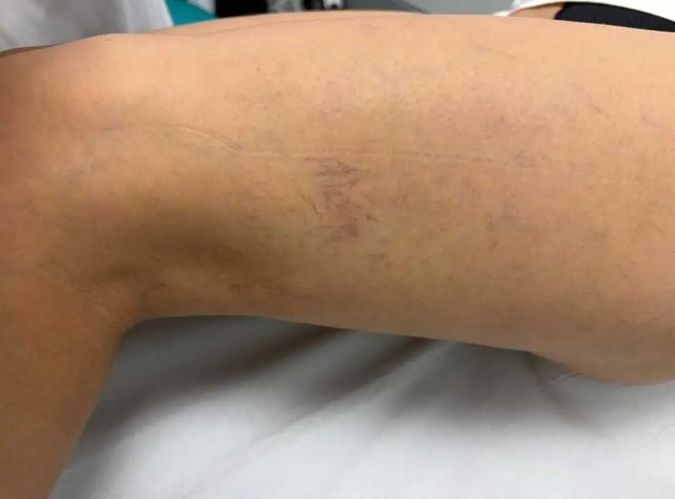 Varices - Quiron
