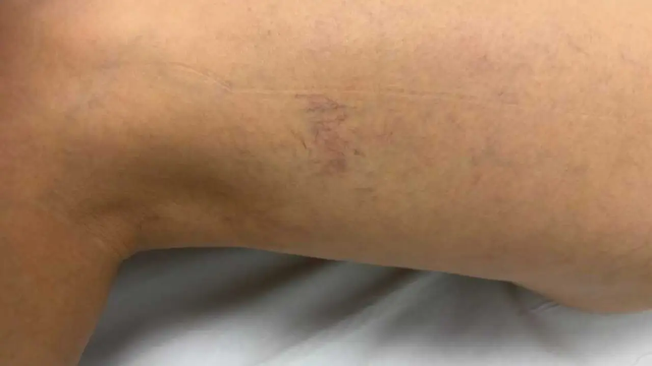 Varices - Quiron